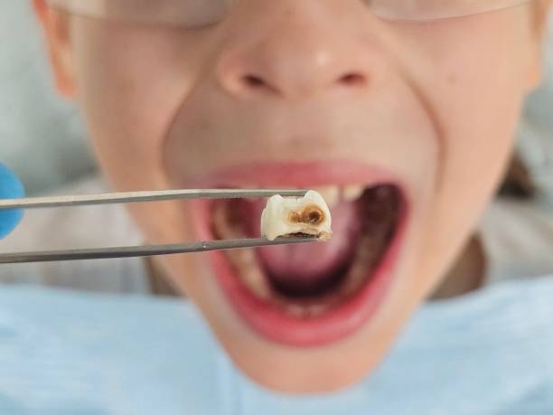 Best Urgent Care for Lost Fillings or Crowns in Somerset, WI